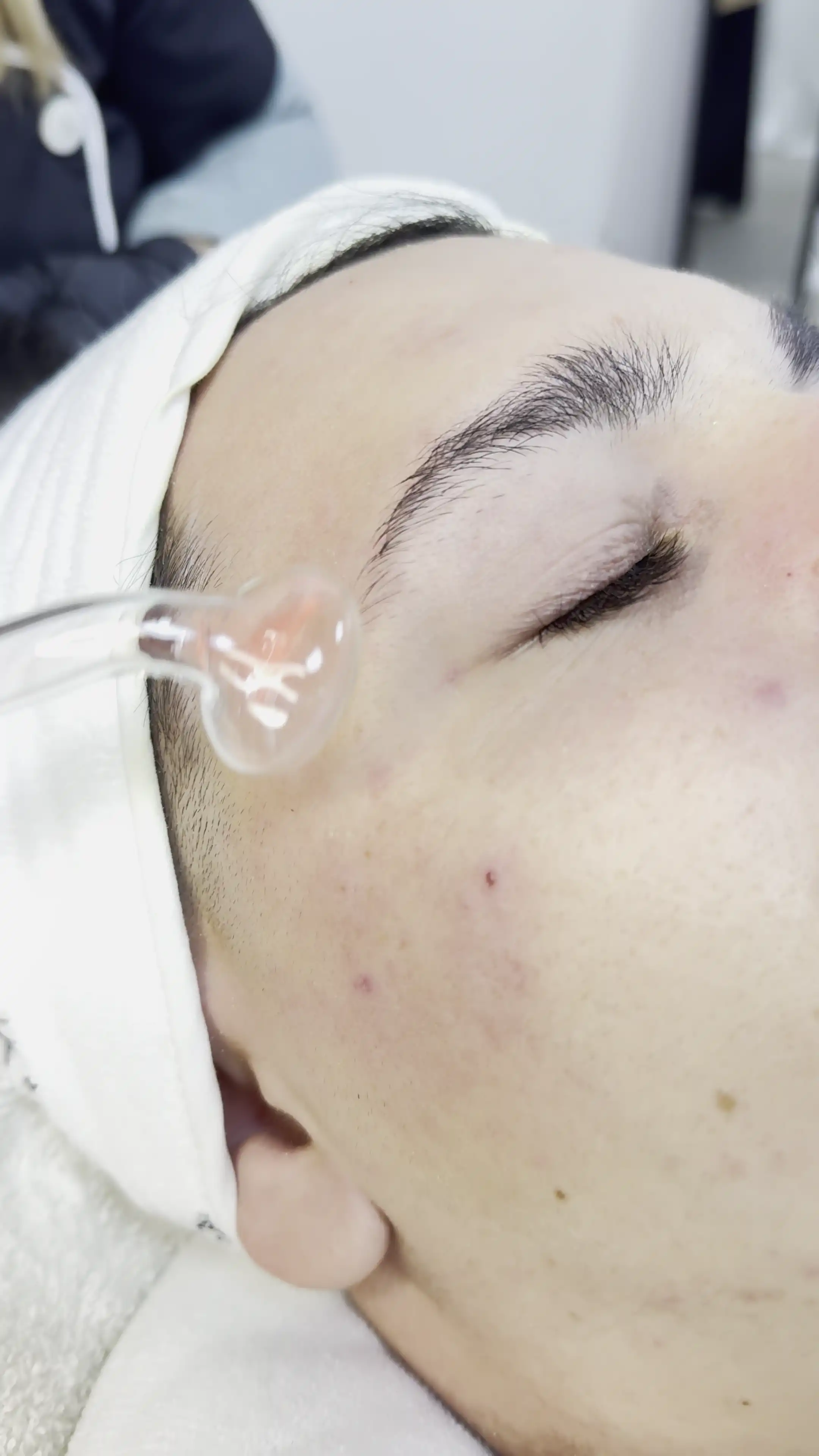 Limpieza Facial Profunda con Extracciones (Acné)